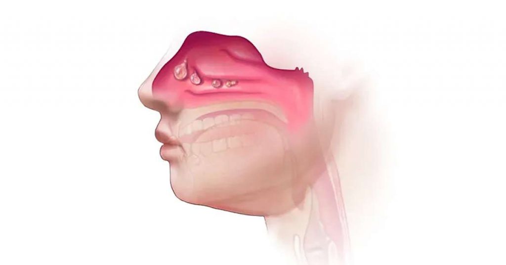 O que causa Obstrução Nasal?